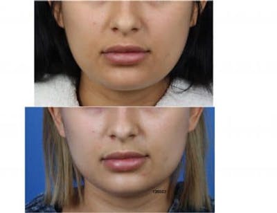 Buccal Fat Removal Before & After Gallery - Patient 37902135 - Image 1