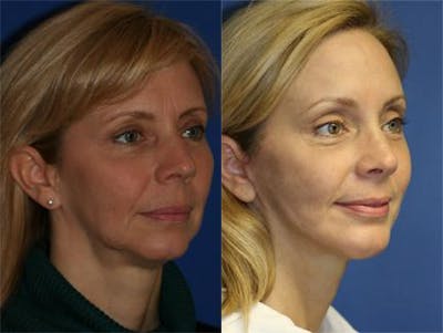 Browlift Before & After Gallery - Patient 37902138 - Image 1