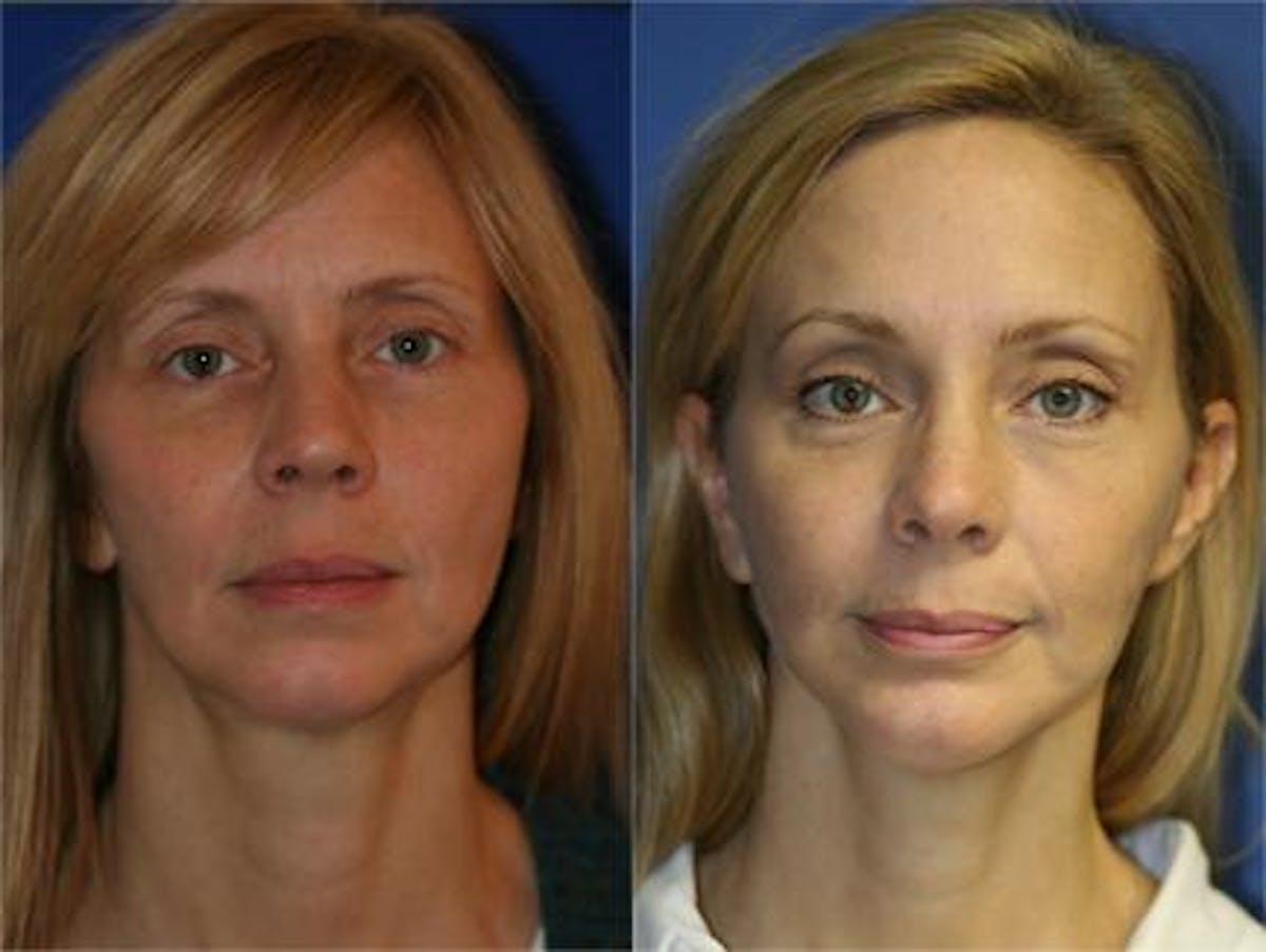 Browlift Before & After Gallery - Patient 37902138 - Image 2