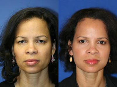 Browlift Before & After Gallery - Patient 37902152 - Image 1