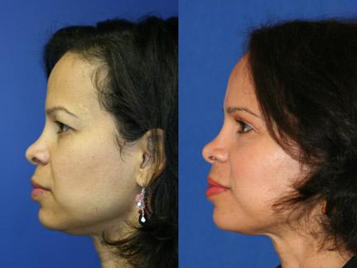Browlift Before & After Gallery - Patient 37902152 - Image 2