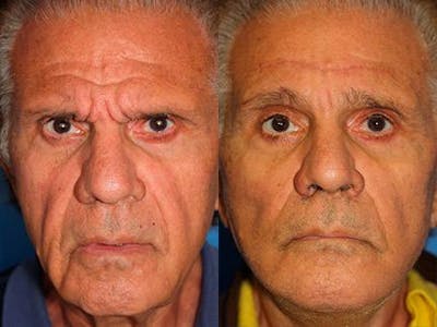 Browlift Before & After Gallery - Patient 37902164 - Image 1