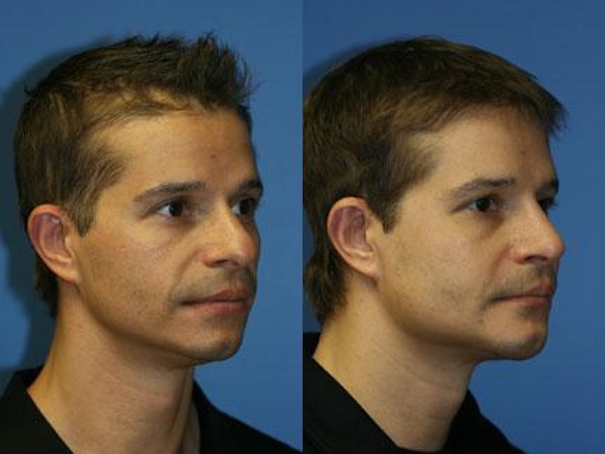 Cheek Implants Before & After Gallery - Patient 37902196 - Image 2