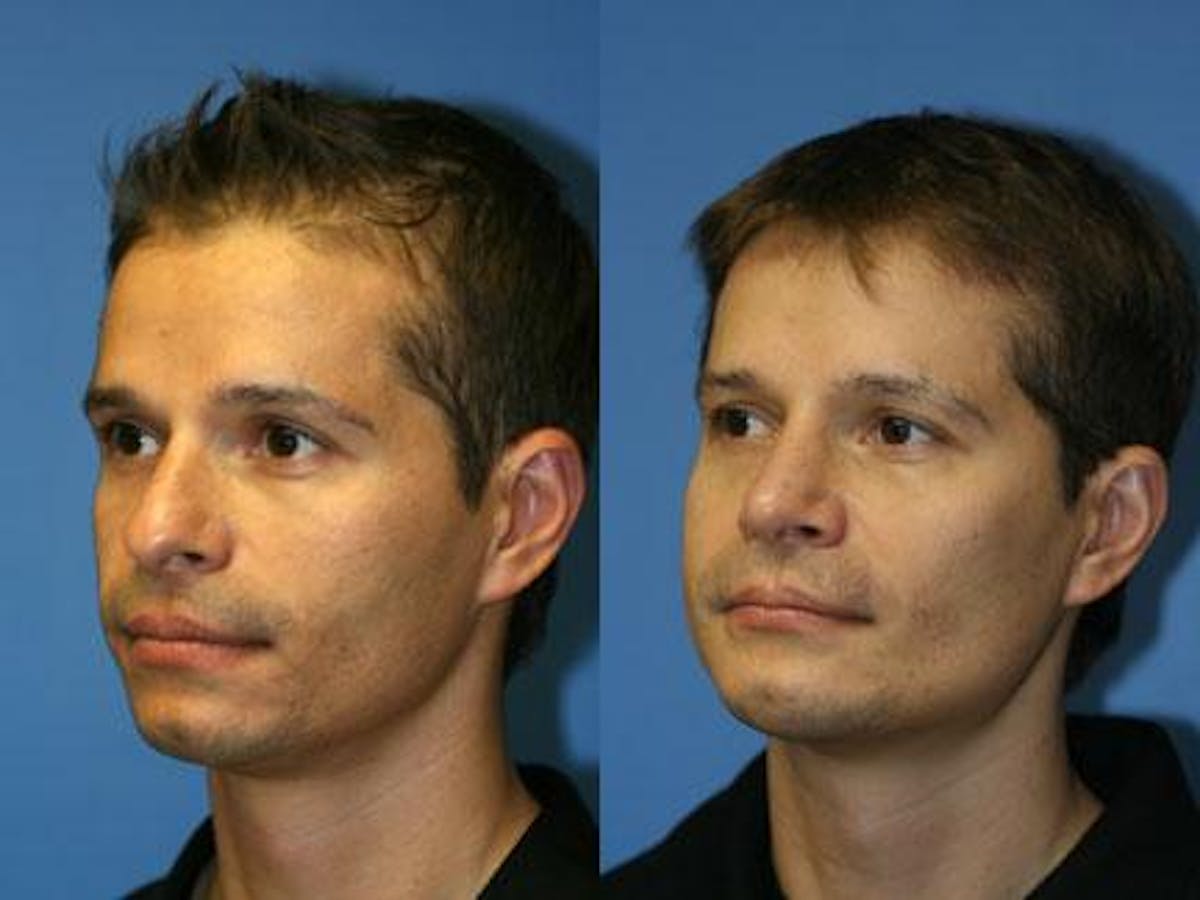 Cheek Implants Before & After Gallery - Patient 37902196 - Image 3