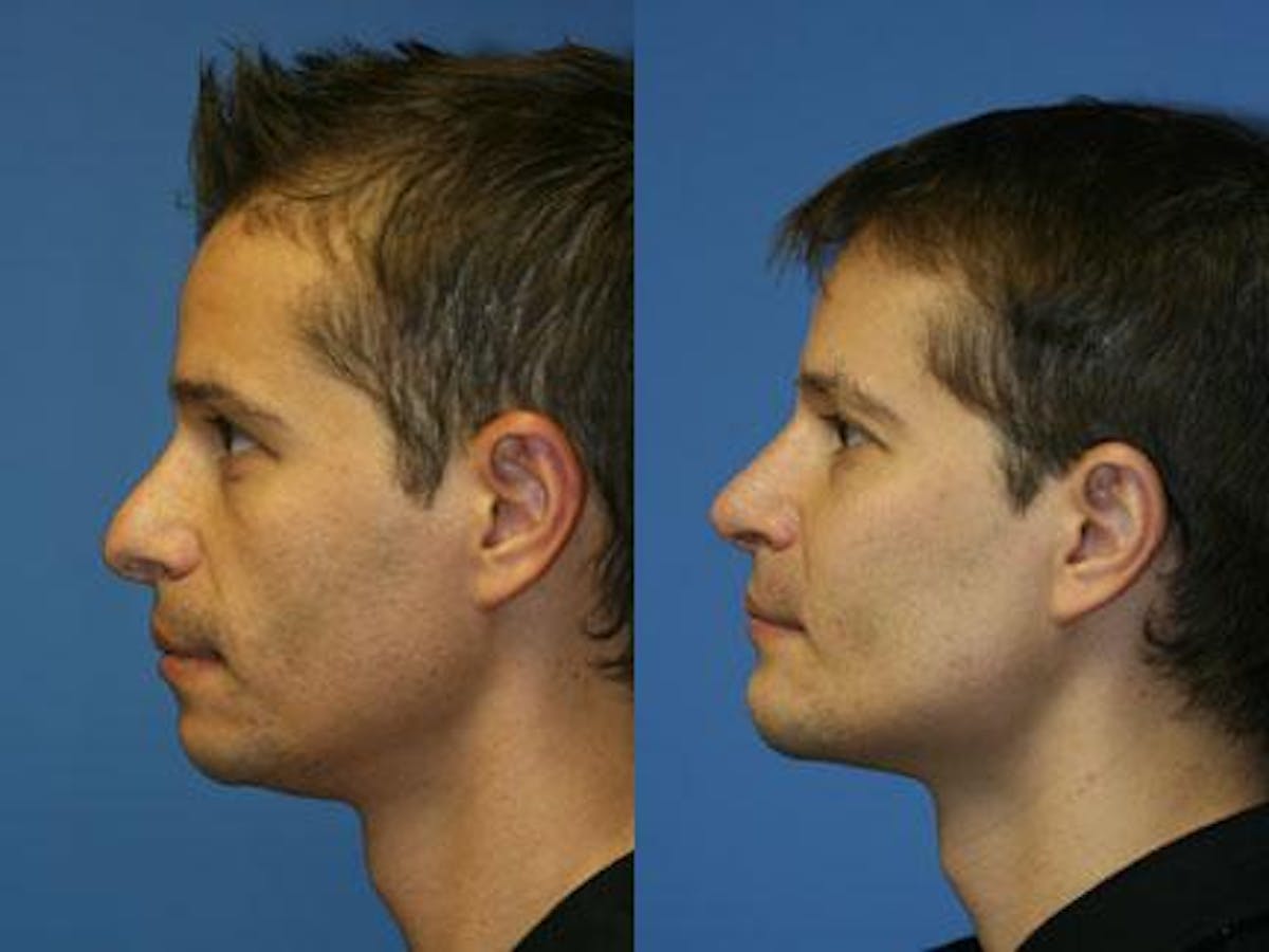 Cheek Implants Before & After Gallery - Patient 37902196 - Image 4