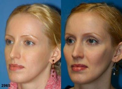 Cheek Implants Before & After Gallery - Patient 37902219 - Image 1