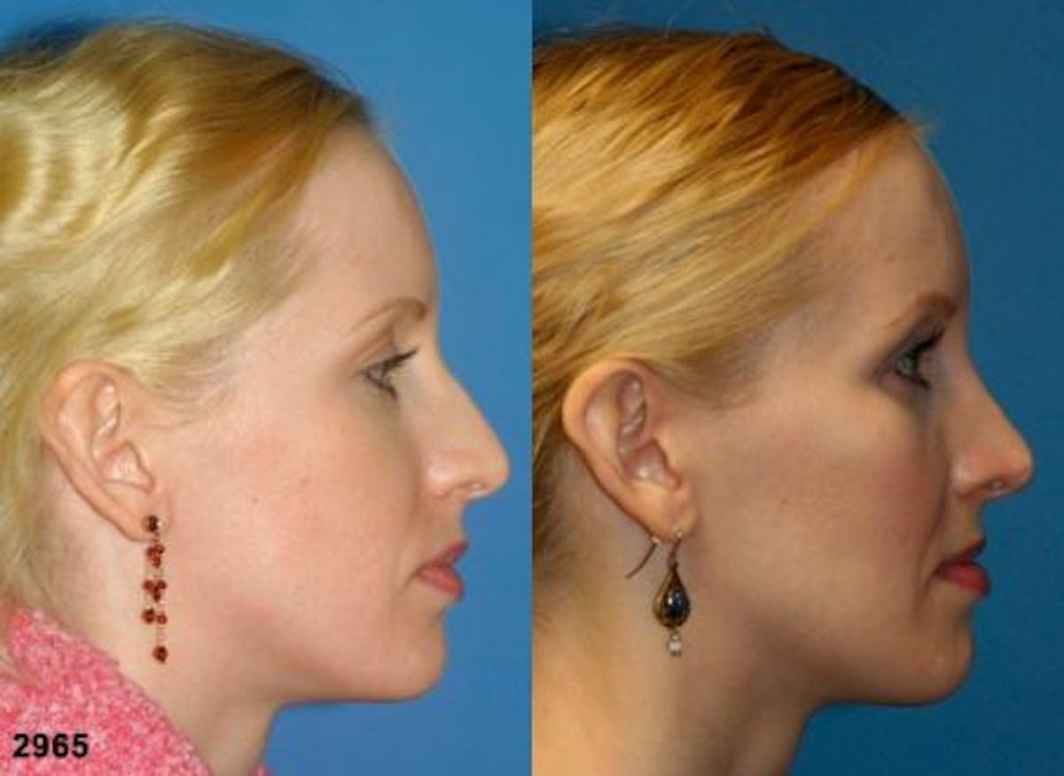 Cheek Implants Before & After Gallery - Patient 37902219 - Image 2