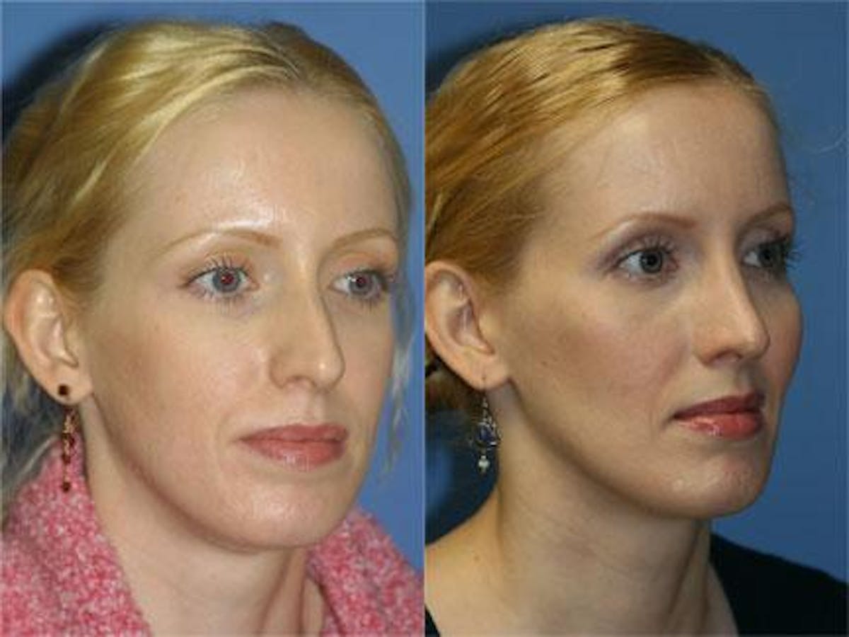 Cheek Implants Before & After Gallery - Patient 37902219 - Image 3