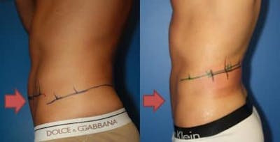 CoolSculpting Before & After Gallery - Patient 37902252 - Image 1