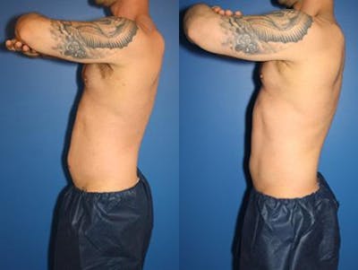 CoolSculpting Before & After Gallery - Patient 37902256 - Image 1