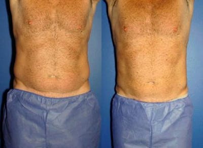 CoolSculpting Before & After Gallery - Patient 37902261 - Image 1