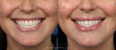 Dermal Fillers Before & After Gallery - Patient 37902301 - Image 1
