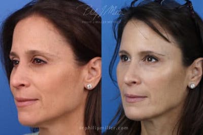 Dermal Fillers Before & After Gallery - Patient 37902305 - Image 1