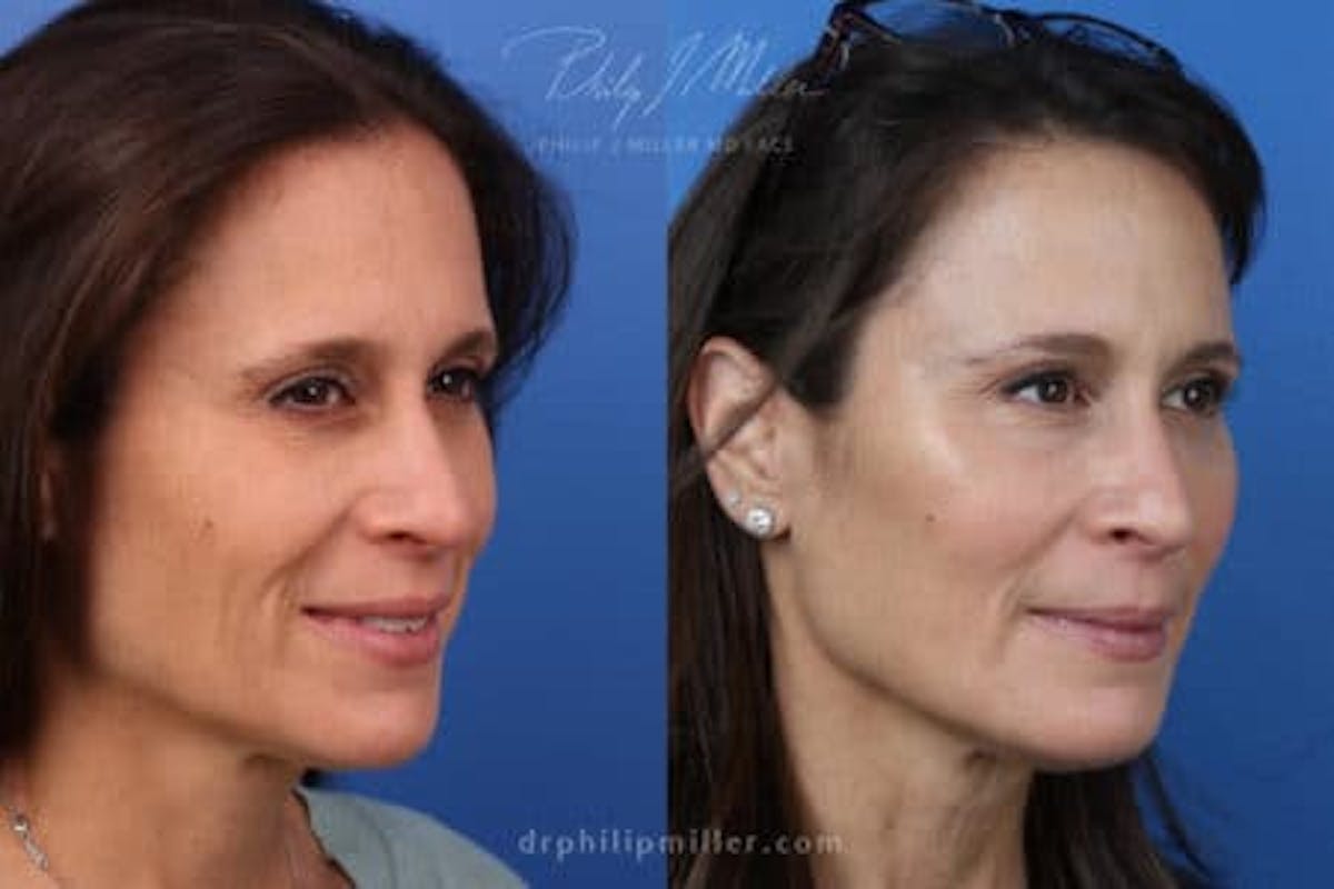 Dermal Fillers Before & After Gallery - Patient 37902305 - Image 2