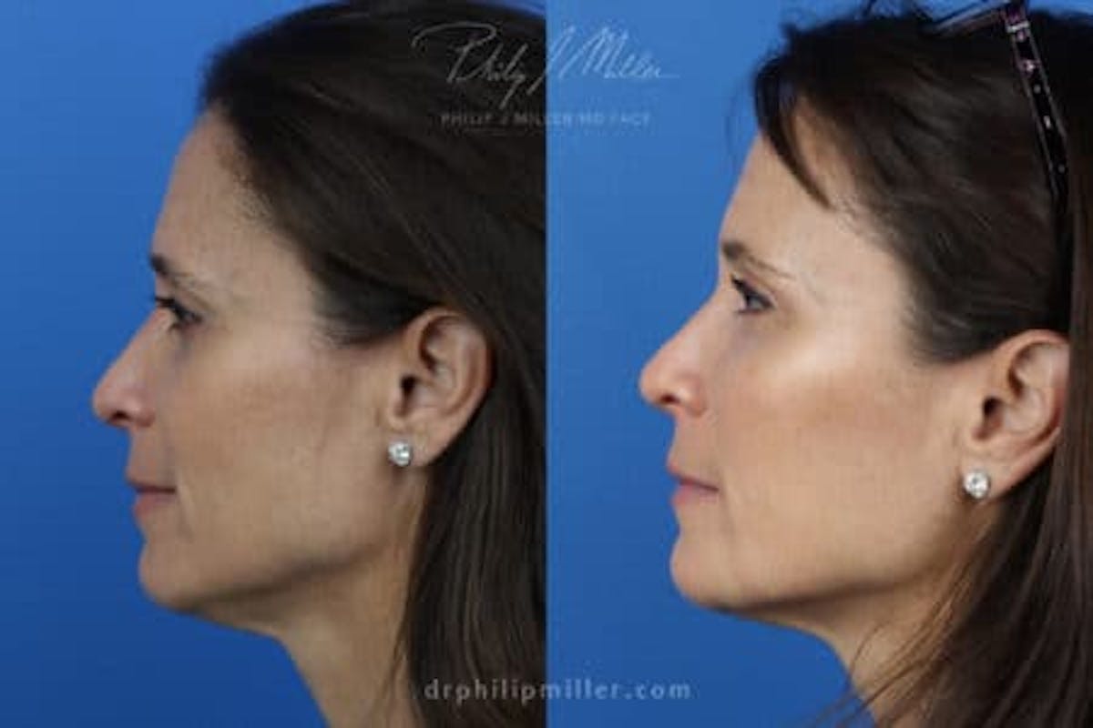 Dermal Fillers Before & After Gallery - Patient 37902305 - Image 3