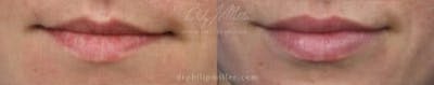 Dermal Fillers Before & After Gallery - Patient 37902323 - Image 1
