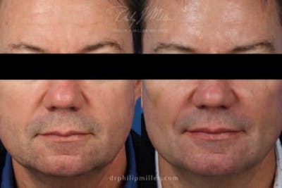 Dermal Fillers Before & After Gallery - Patient 37902328 - Image 1