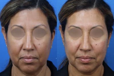 Dermal Fillers Before & After Gallery - Patient 37902341 - Image 1