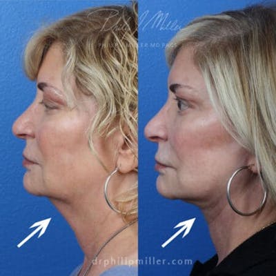 Facelift/NatraLift Before & After Gallery - Patient 37903595 - Image 1