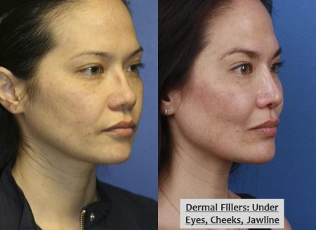 Dermal Fillers Woman's profile showing Before and After Dermal Fillers