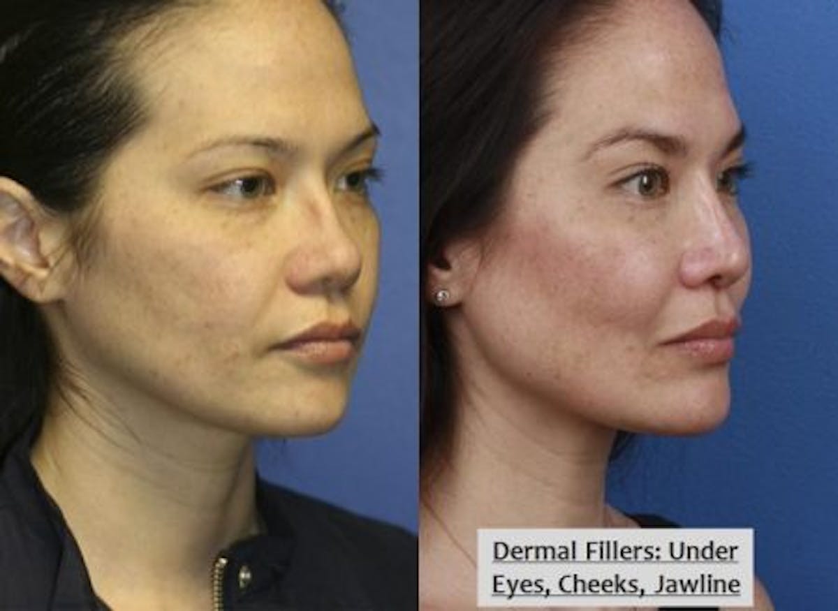 Dermal Fillers Before & After Gallery - Patient 37903605 - Image 1