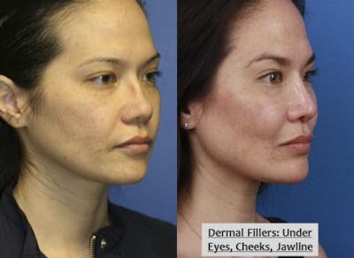 Dermal Fillers Before & After Gallery - Patient 37903605 - Image 1