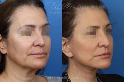 Facelift/NatraLift Before & After Gallery - Patient 37903642 - Image 1