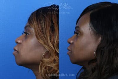 Ethnic Rhinoplasty Before & After Gallery - Patient 37903648 - Image 1