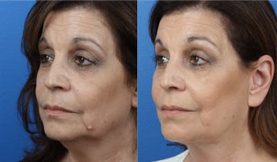 Fat Injections Before & After Gallery - Patient 37903652 - Image 1