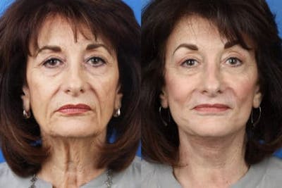 Facelift/NatraLift Before & After Gallery - Patient 37903655 - Image 1