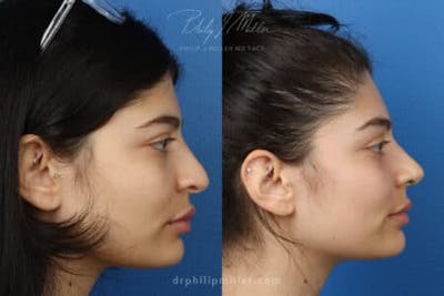 Ethnic Rhinoplasty Before & After Gallery - Patient 37903663 - Image 1