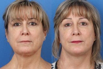Facelift/NatraLift Before & After Gallery - Patient 37903673 - Image 1