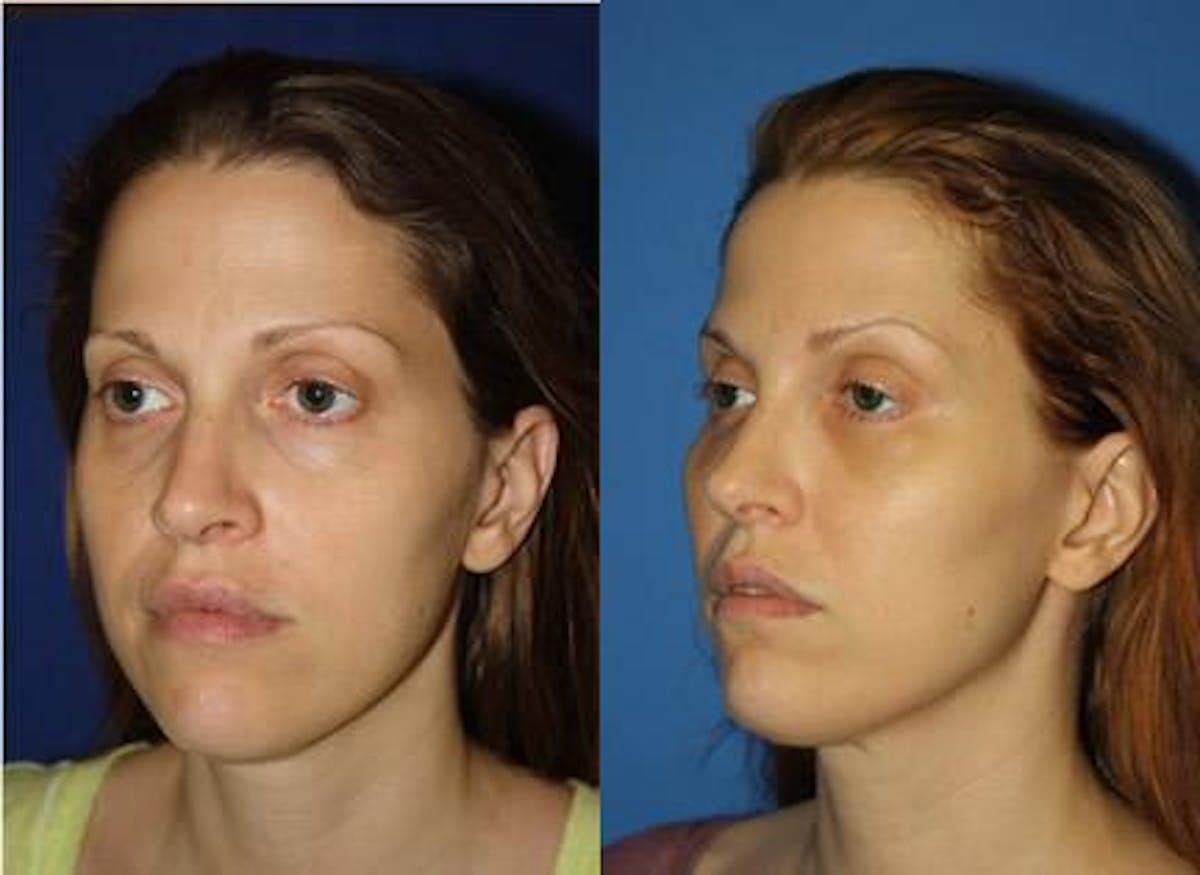 Fat Injections Before & After Gallery - Patient 37903680 - Image 1