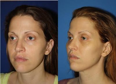 Fat Injections Before & After Gallery - Patient 37903680 - Image 1