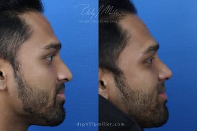 Ethnic Rhinoplasty Before & After Gallery - Patient 37903681 - Image 1
