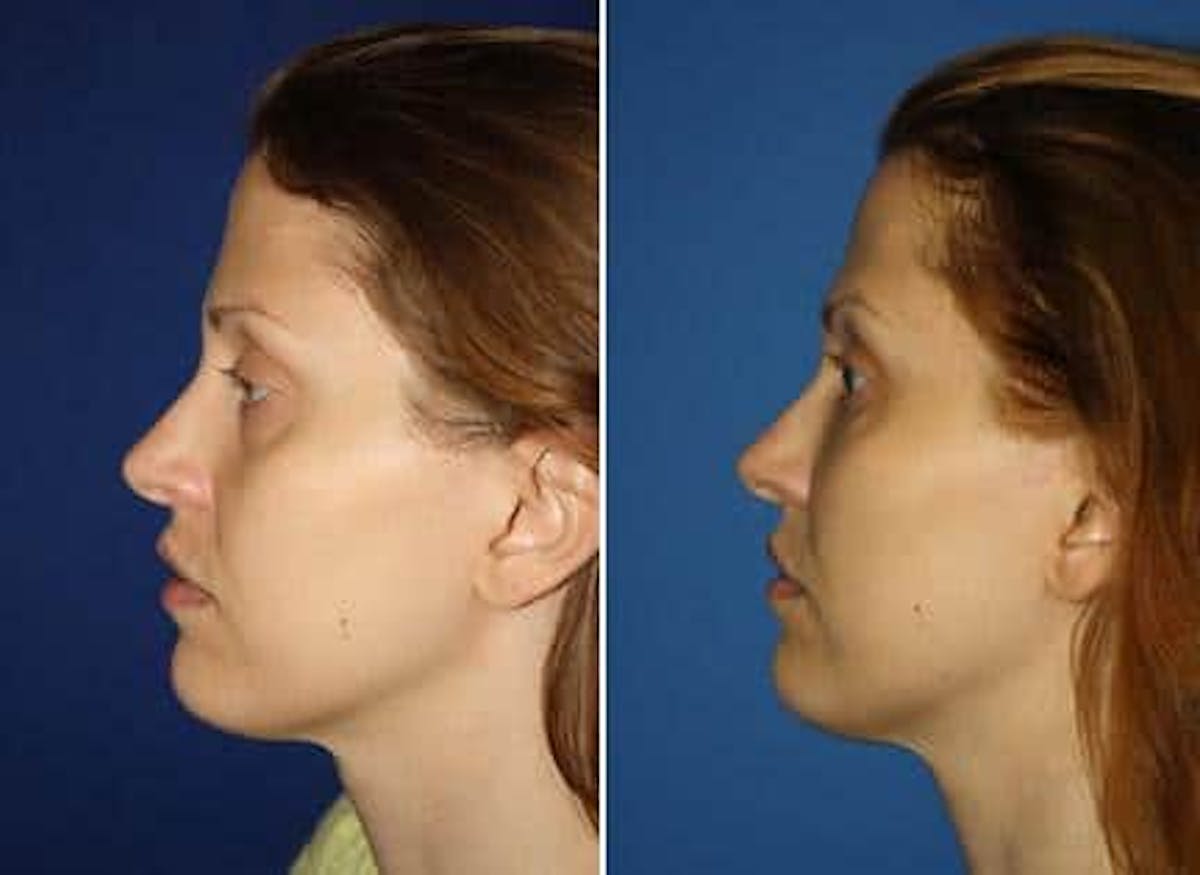 Fat Injections Before & After Gallery - Patient 37903680 - Image 2