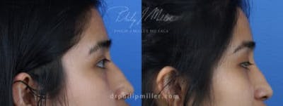 Ethnic Rhinoplasty Before & After Gallery - Patient 37903700 - Image 1