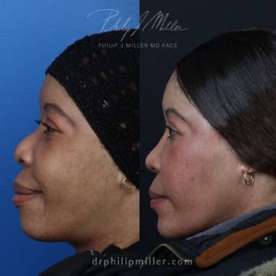 G. I. Jaw/Chin Contouring Before & After Gallery - Patient 37903701 - Image 1