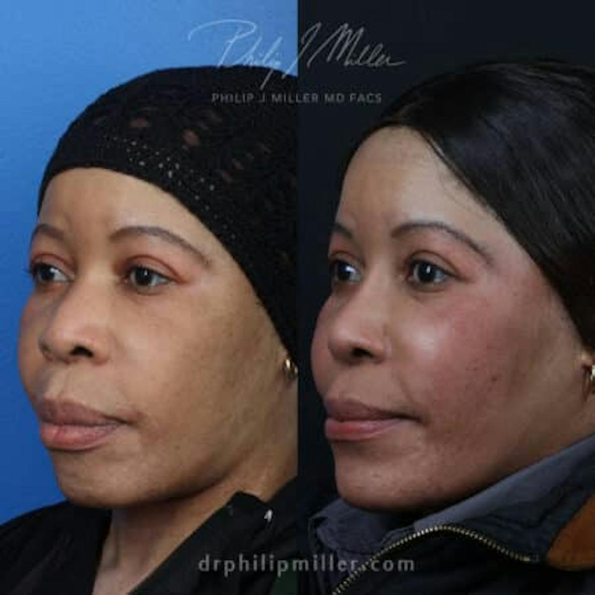 G. I. Jaw/Chin Contouring Before & After Gallery - Patient 37903701 - Image 2
