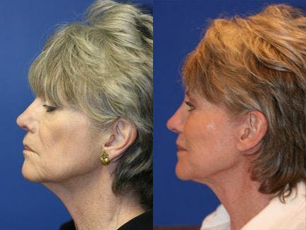 Facelift/NatraLift Before & After Gallery - Patient 37903698 - Image 4