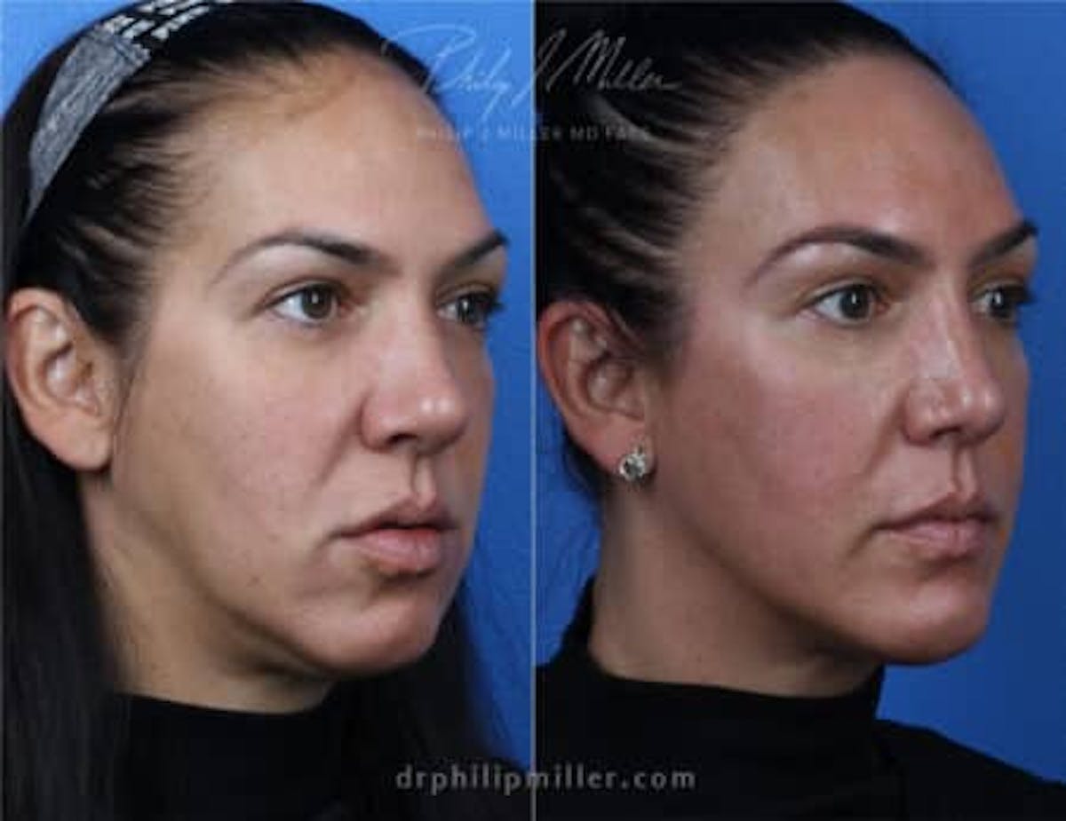 G. I. Jaw/Chin Contouring Before & After Gallery - Patient 37903713 - Image 2