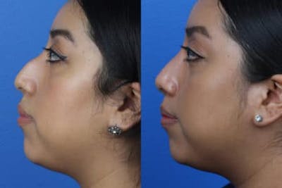 Ethnic Rhinoplasty Before & After Gallery - Patient 37903724 - Image 1