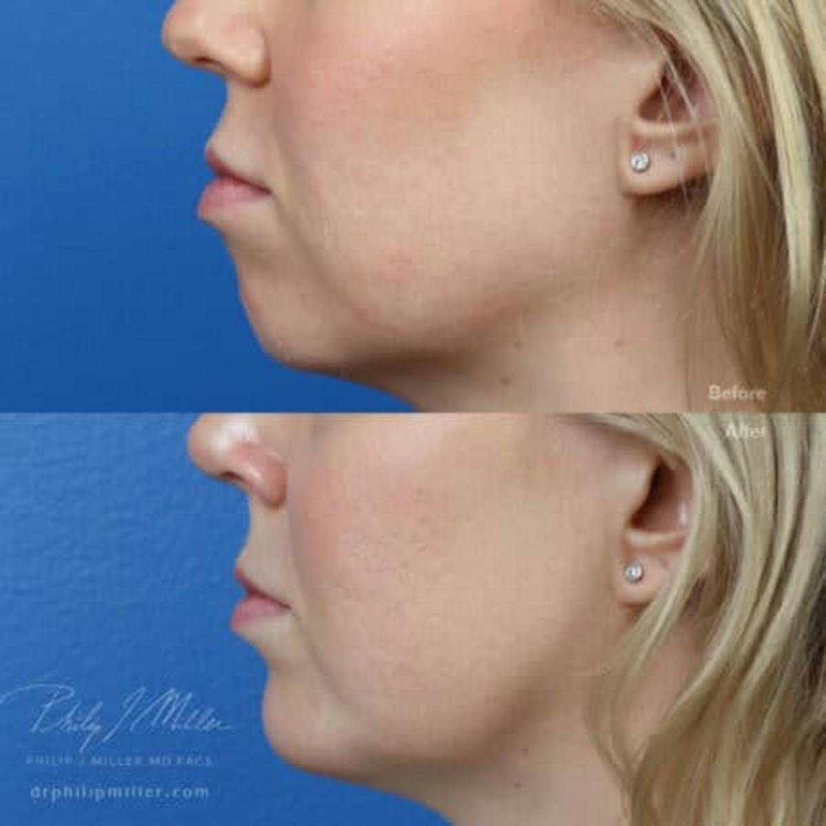 G. I. Jaw/Chin Contouring Before & After Gallery - Patient 37903725 - Image 1