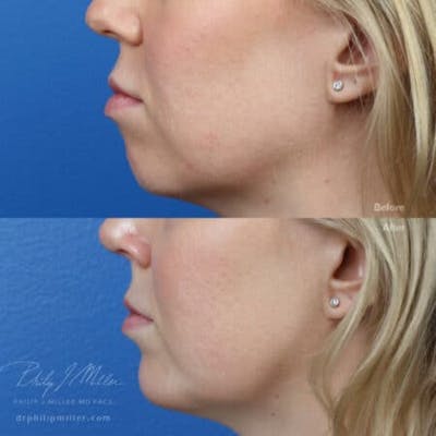 G. I. Jaw/Chin Contouring Before & After Gallery - Patient 37903725 - Image 1
