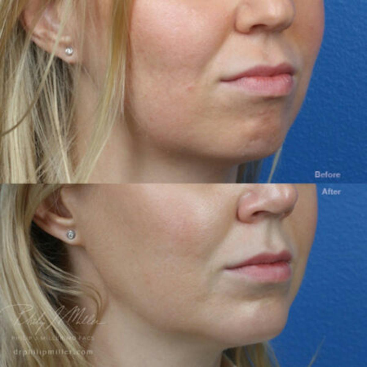 G. I. Jaw/Chin Contouring Before & After Gallery - Patient 37903725 - Image 2