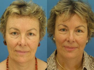 Facelift/NatraLift Before & After Gallery - Patient 37903734 - Image 1