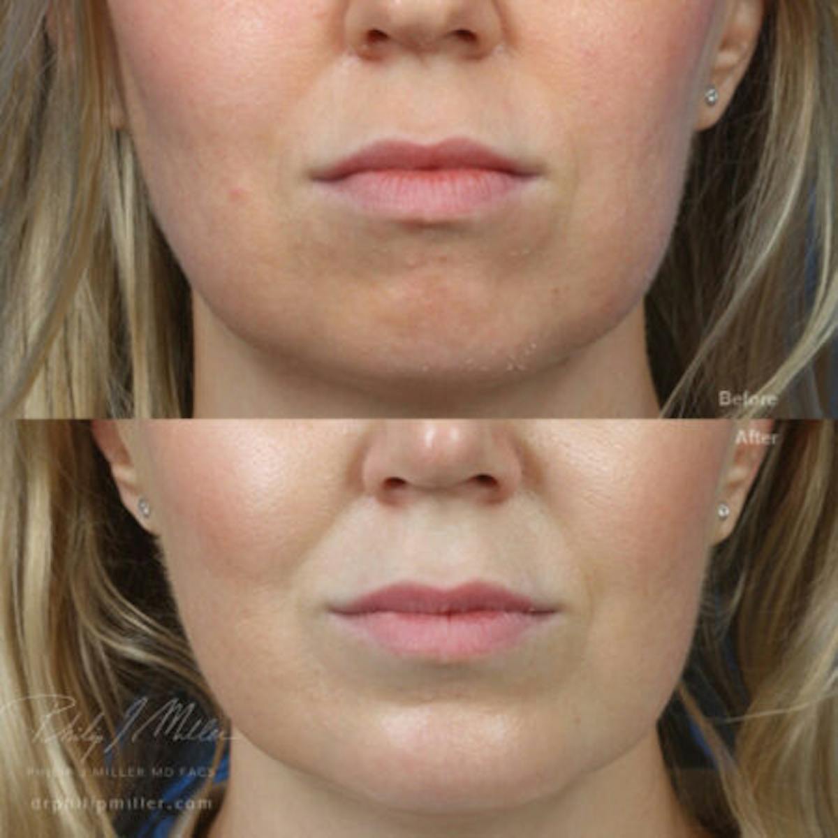 G. I. Jaw/Chin Contouring Before & After Gallery - Patient 37903725 - Image 3
