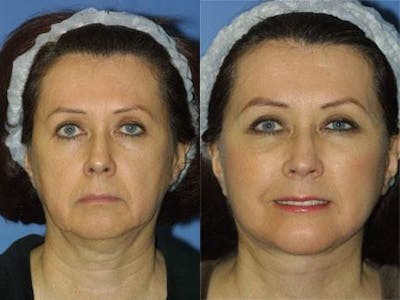 Facelift/NatraLift Before & After Gallery - Patient 37903752 - Image 1