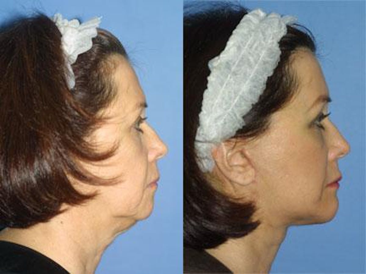 Facelift/NatraLift Before & After Gallery - Patient 37903752 - Image 2