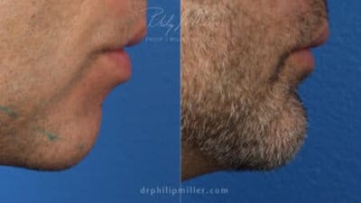 G. I. Jaw/Chin Contouring Before & After Gallery - Patient 37903759 - Image 1
